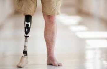 تركيب أطراف صناعية